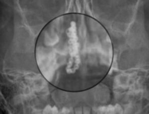 5 yaşındaki çocuğun burnundan çıkan hekimleri hayrete düşürdü: Küçücük burna nasıl girmiş?